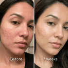 Clinical Acne Scar Repair Stick