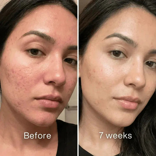 Clinical Acne Scar Repair Stick