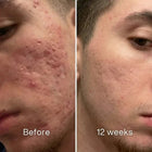 Clinical Acne Scar Repair Stick