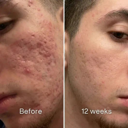 Clinical Acne Scar Repair Stick